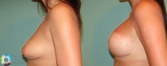 Before & After Breast Augmentation Case 666 View #4 View in Golden, CO