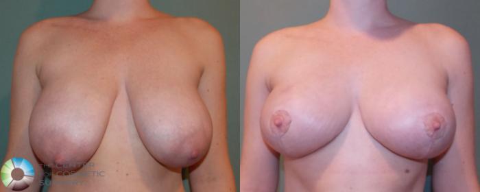 Before & After Breast Lift without Implants Case 690 View #1 View in Golden, CO