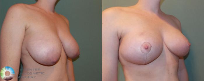 Before & After Breast Lift without Implants Case 690 View #2 View in Golden, CO