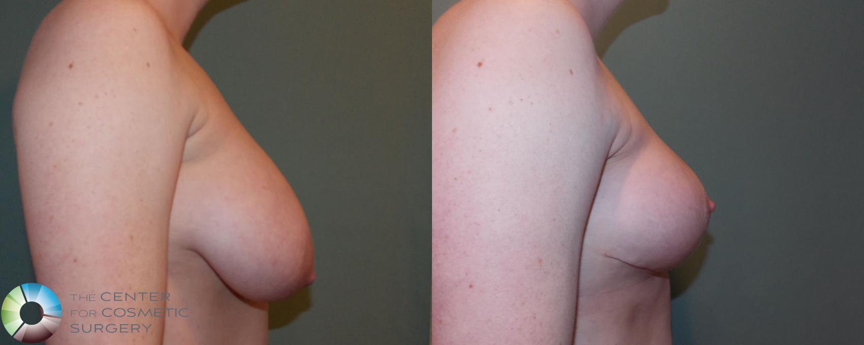 Before & After Breast Lift Case 690 View #3 View in Golden, CO