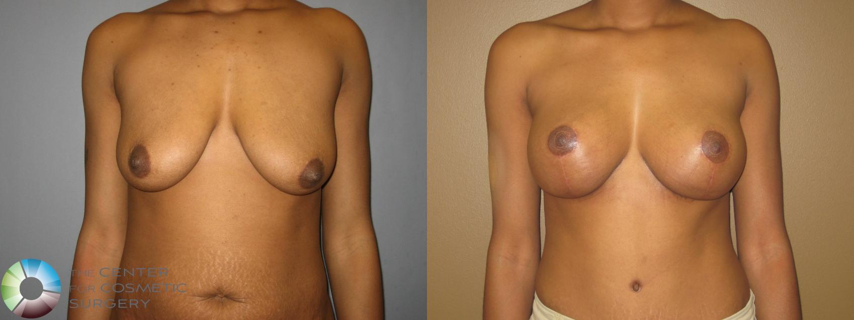 Before & After Breast Lift Case 714 View #1 in Denver and Colorado Springs, CO