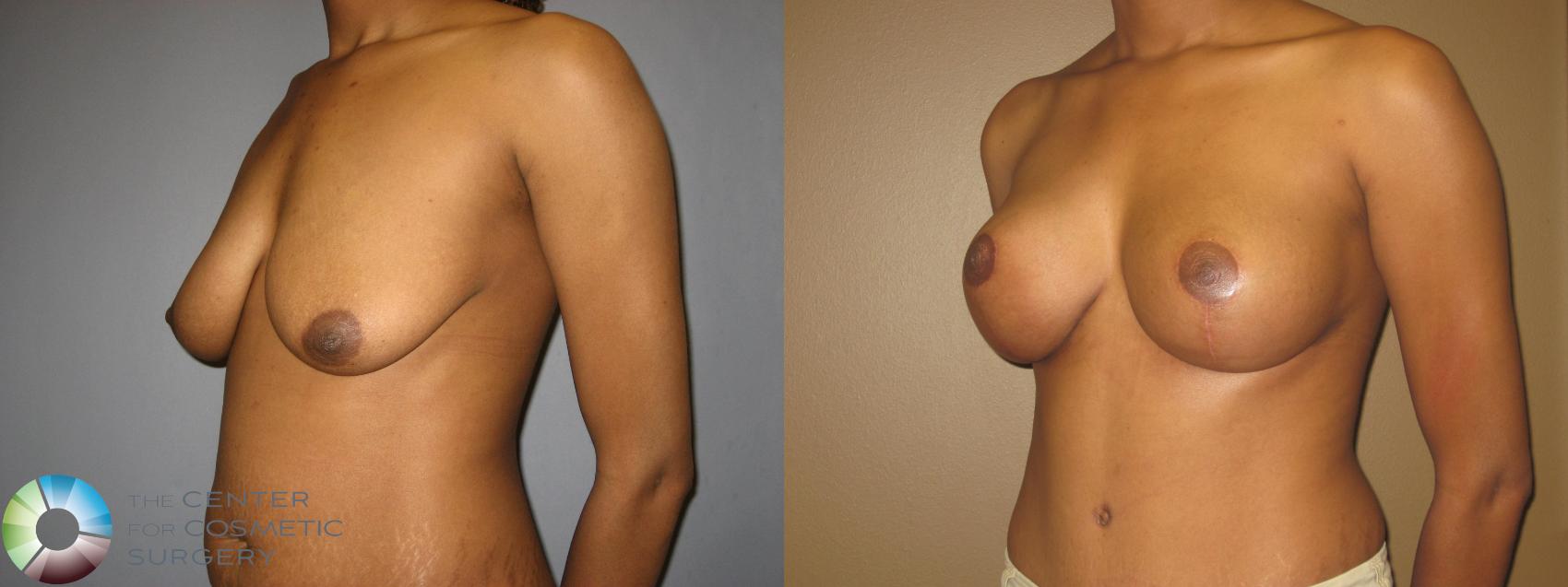 Before & After Breast Lift Case 714 View #2 in Denver and Colorado Springs, CO