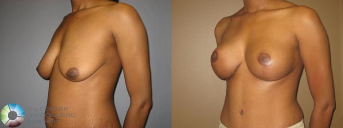 Before & After Breast Lift Case 714 View #2 View in Golden, CO