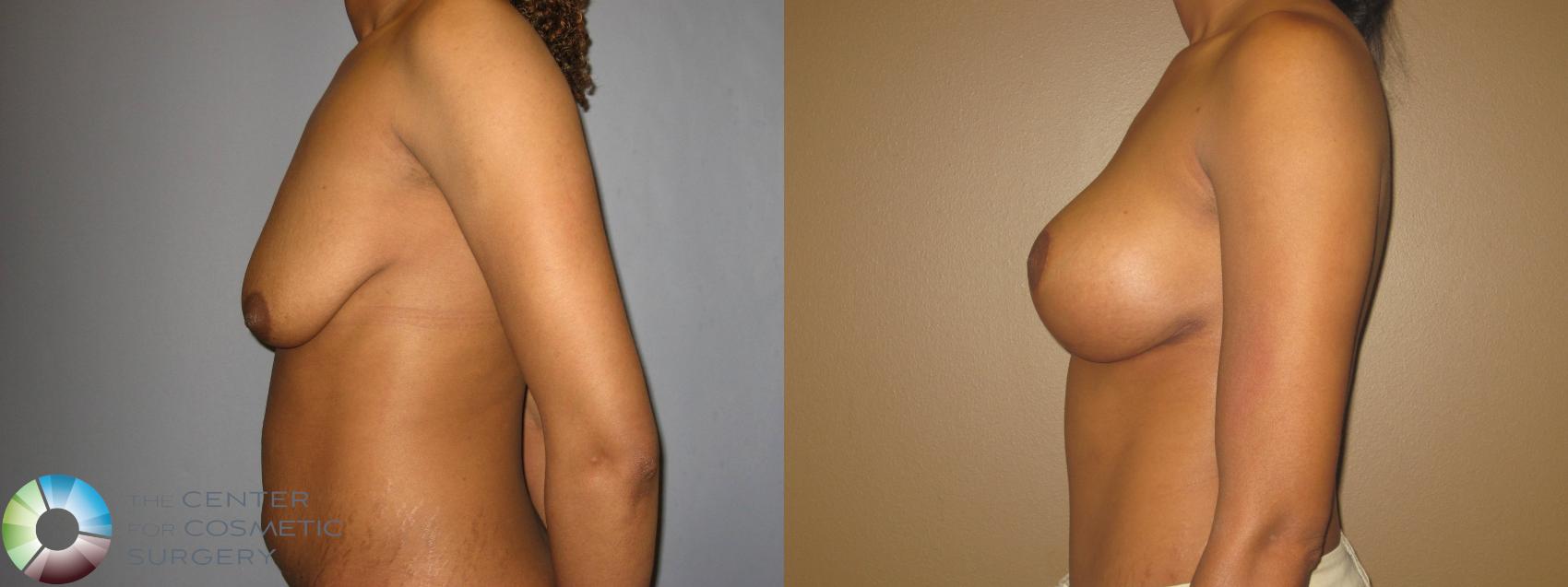 Before & After Breast Lift Case 714 View #3 in Denver and Colorado Springs, CO
