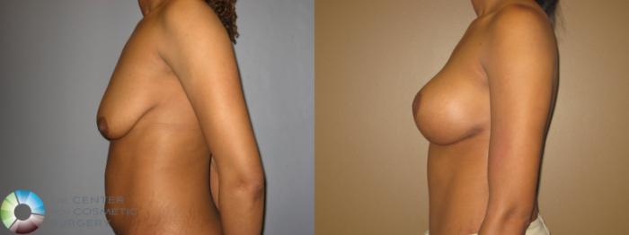 Before & After Breast Lift Case 714 View #3 View in Golden, CO