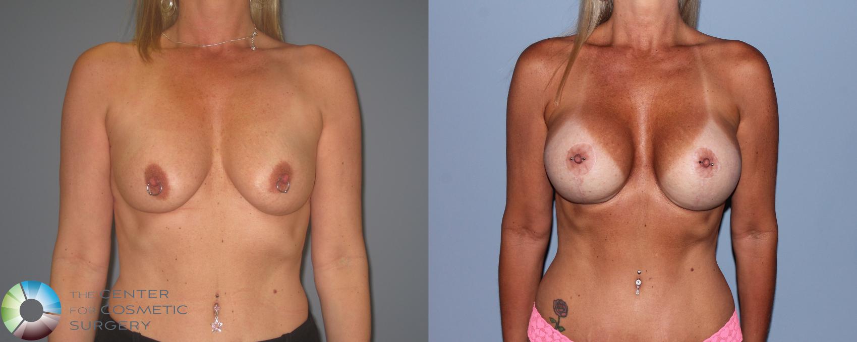 Before & After Breast Lift Case 721 View #1 View in Golden, CO
