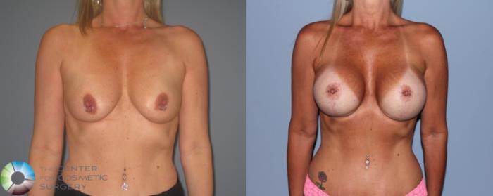 Before & After Breast Lift Case 721 View #1 in Denver and Colorado Springs, CO