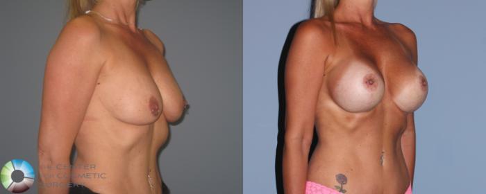 Before & After Breast Lift Case 721 View #2 in Denver and Colorado Springs, CO
