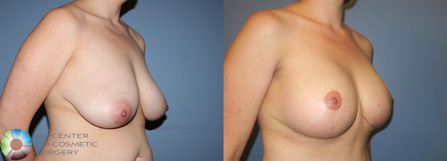 Before & After Breast Lift Case 781 View #1 in Denver and Colorado Springs, CO