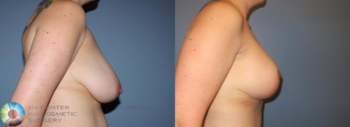 Before & After Breast Augmentation Case 781 View #2 View in Golden, CO