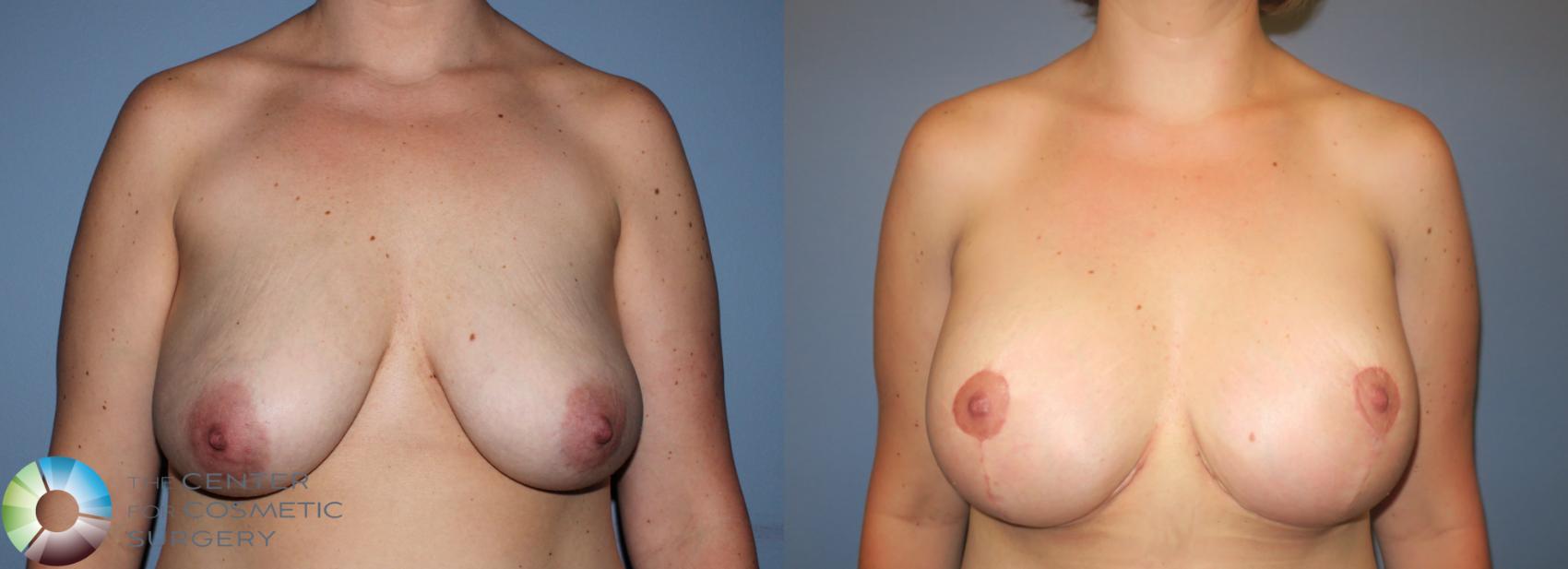 Before & After Breast Lift Case 781 View #3 View in Golden, CO