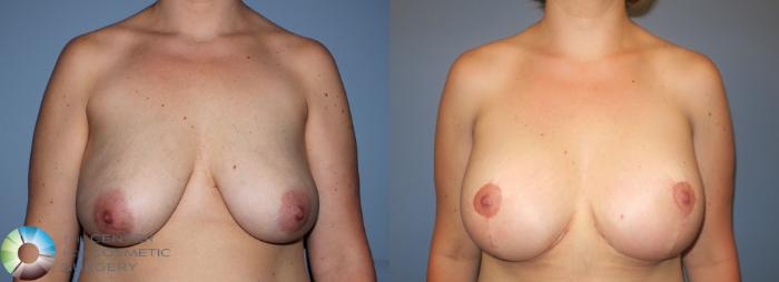 Before & After Breast Augmentation Case 781 View #3 View in Golden, CO