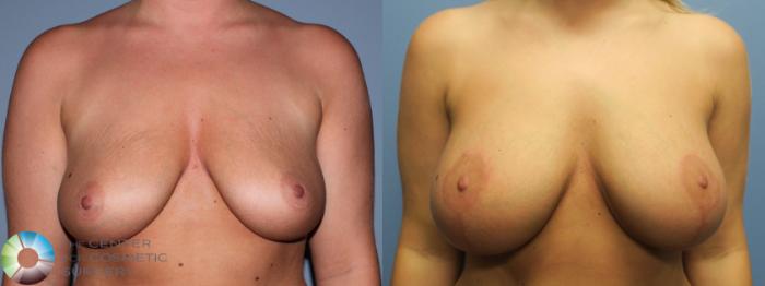 Before & After Breast Lift Case 787 Front View in Golden, CO