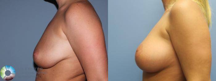 Before & After Breast Lift Case 787 Left Lateral View in Golden, CO