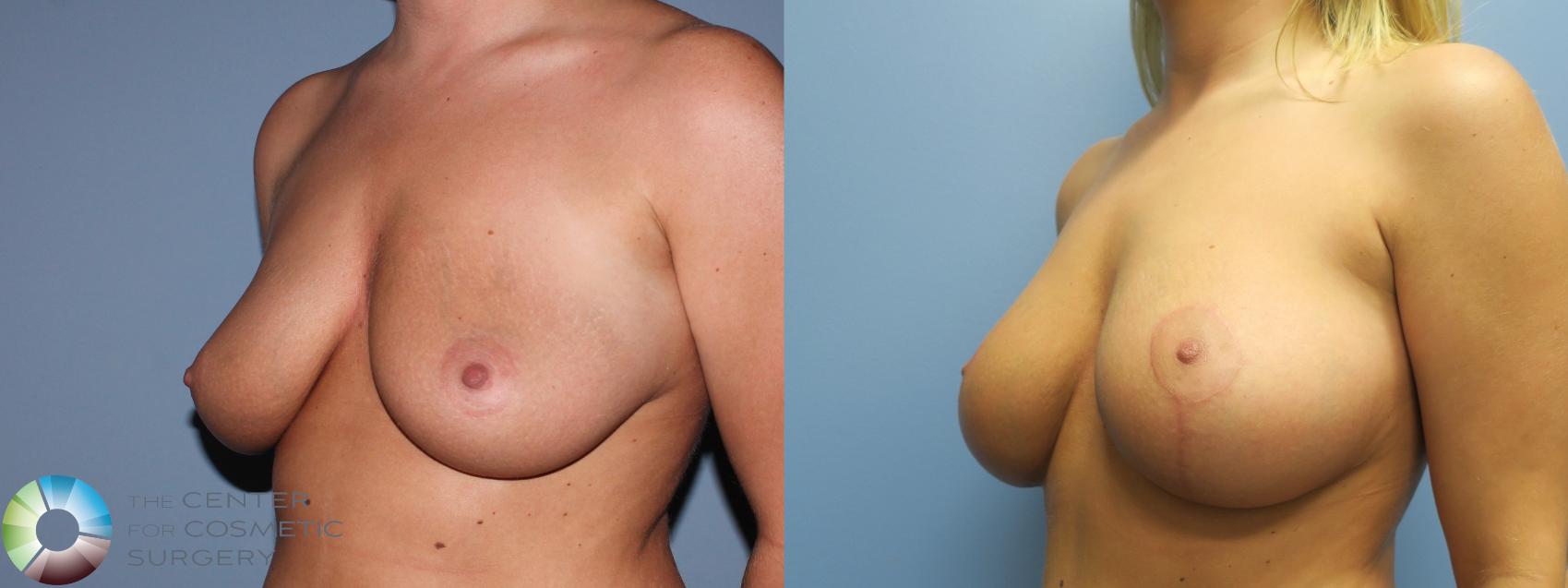 Before & After Breast Lift Case 787 Left Oblique in Denver and Colorado Springs, CO