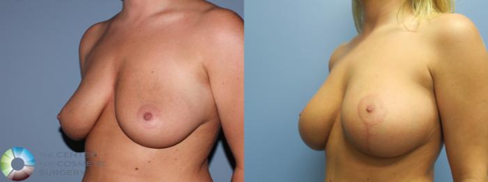 Before & After Breast Lift Case 787 Left Oblique View in Golden, CO