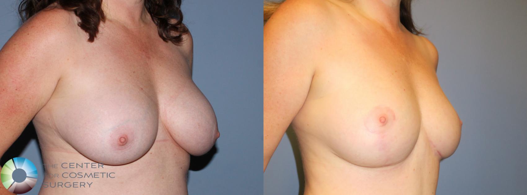 Before & After Breast Implant Revision Case 797 View #1 in Denver and Colorado Springs, CO