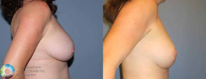 Before & After Breast Lift Case 797 View #3 in Denver and Colorado Springs, CO
