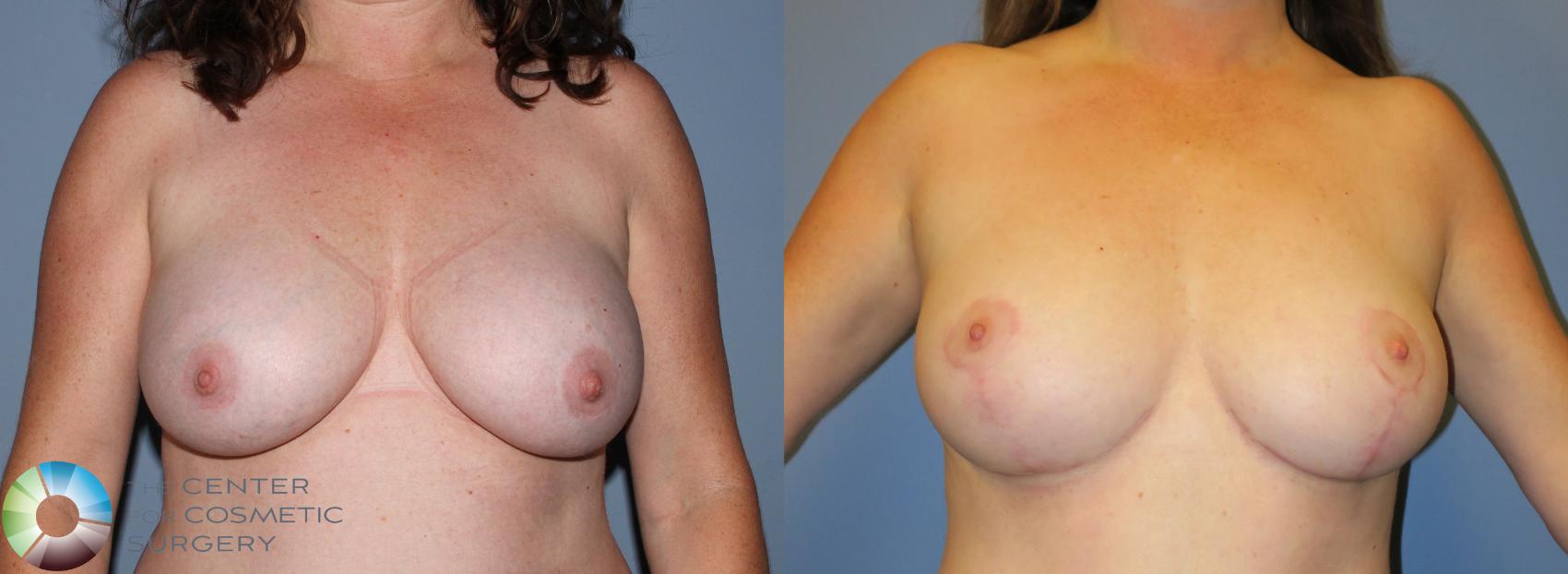 Before & After Breast Lift Case 797 View #4 in Denver and Colorado Springs, CO