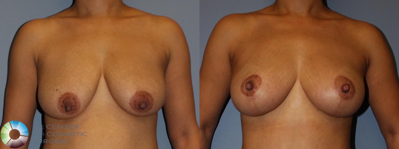 Before & After Breast Lift without Implants Case 808 Anterior in Denver and Colorado Springs, CO