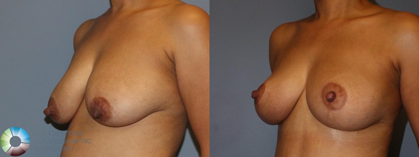 Before & After Breast Lift Case 808 Left Oblique in Denver and Colorado Springs, CO