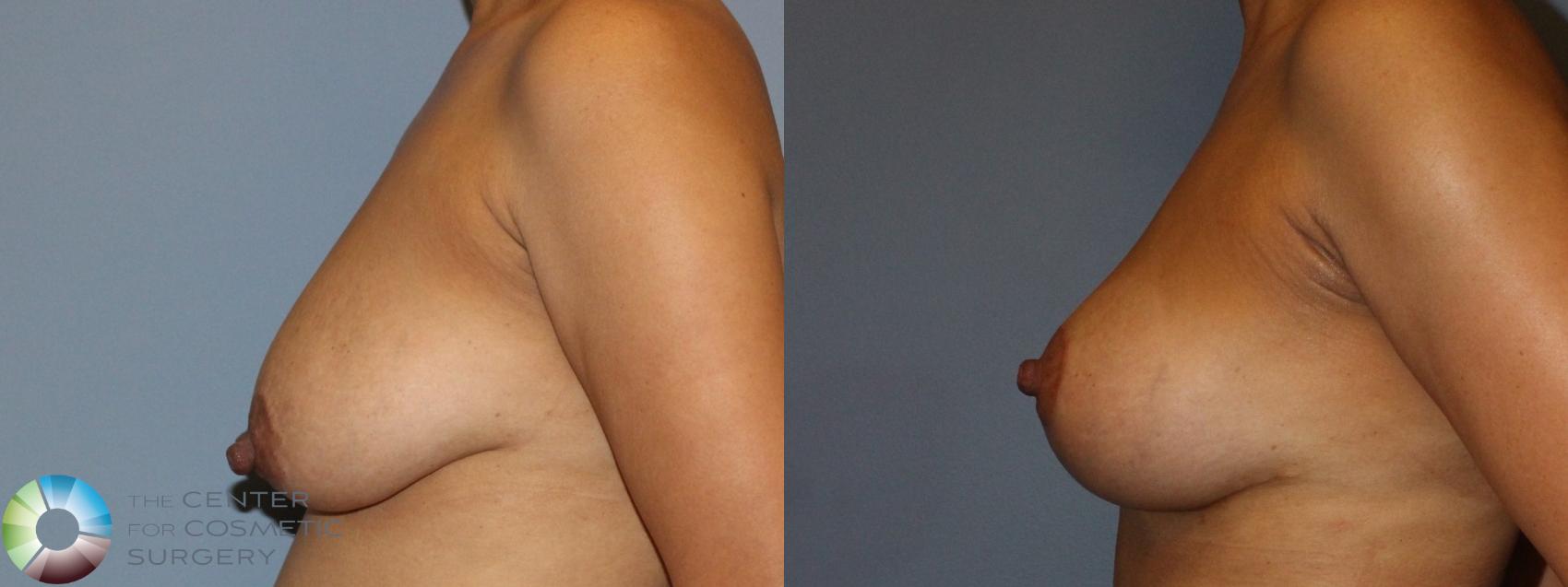 Before & After Breast Lift Case 808 Left Side in Denver and Colorado Springs, CO