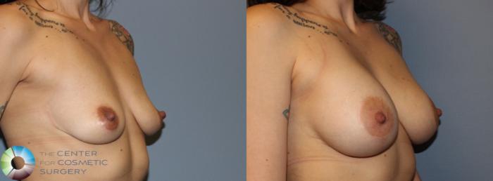Before & After Breast Lift Case 832 View #1 View in Golden, CO