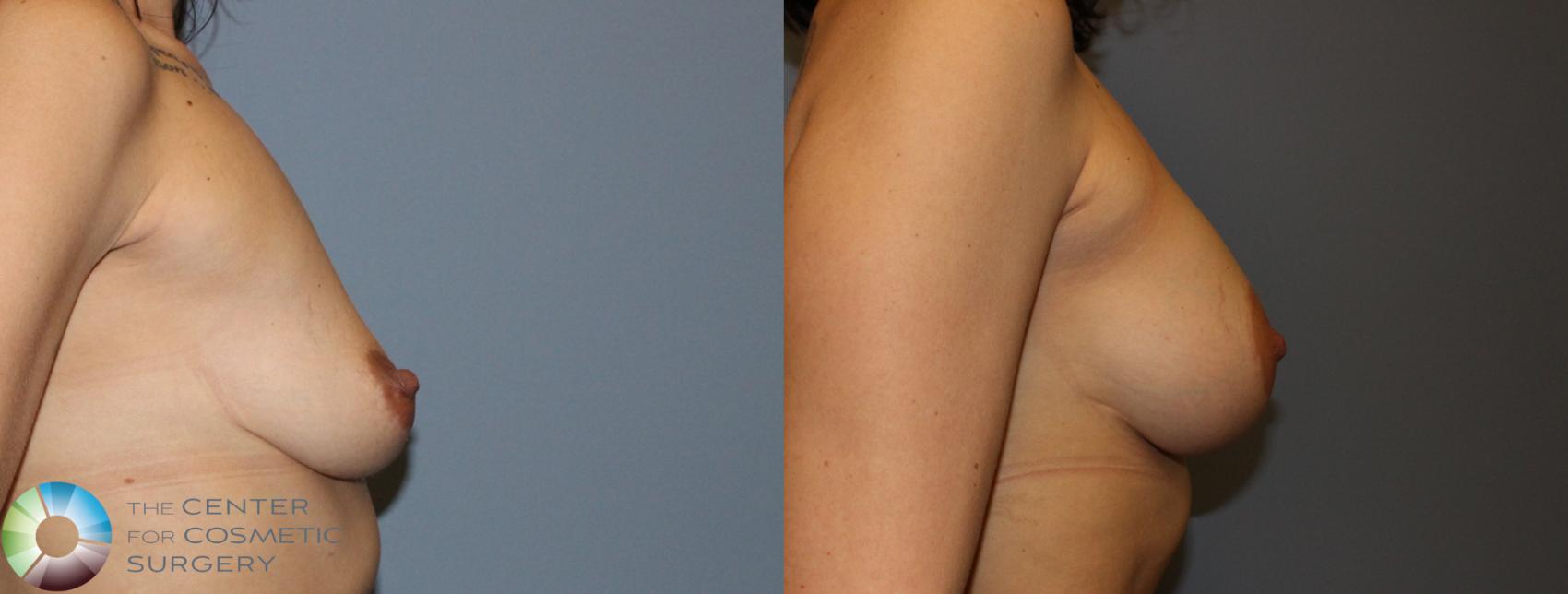 Before & After Breast Lift Case 832 View #2 in Denver and Colorado Springs, CO