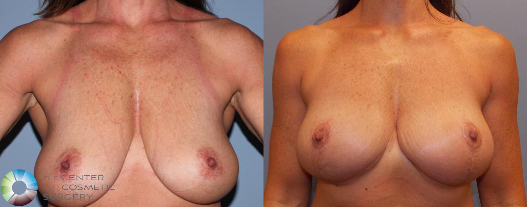 Before & After Breast Lift Case 868 View #1 in Denver and Colorado Springs, CO