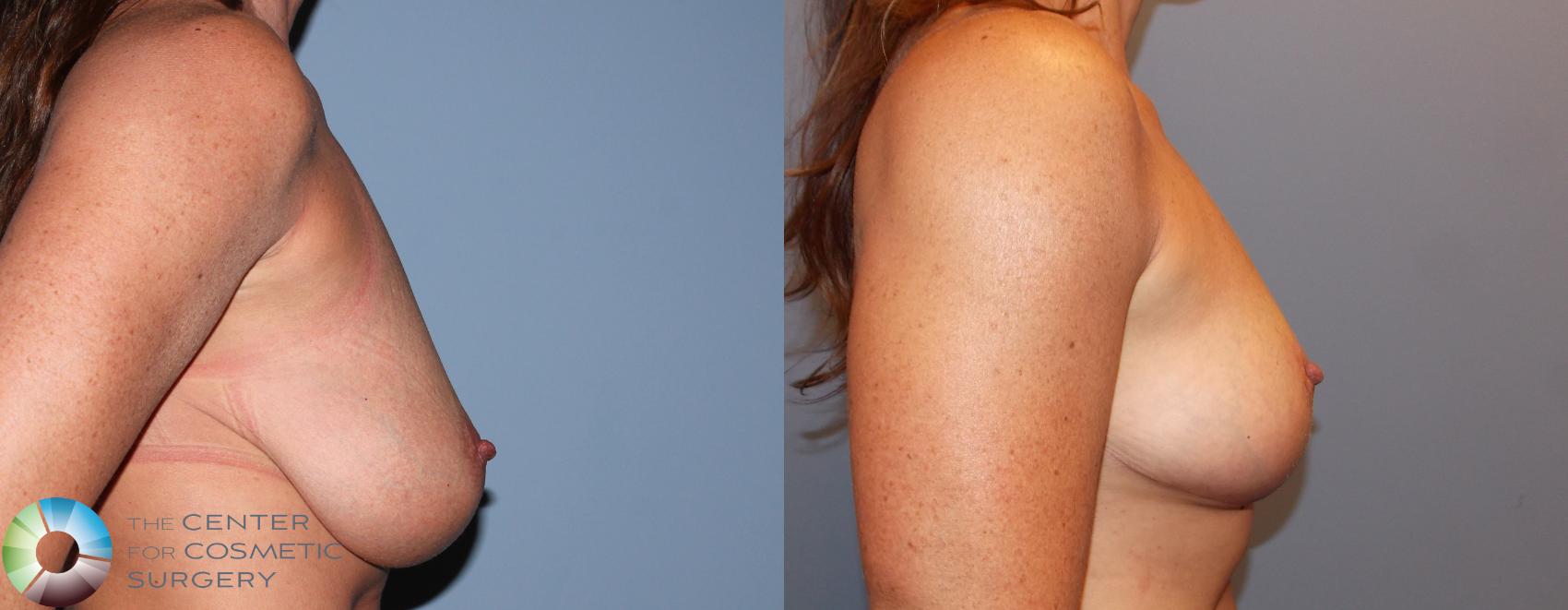 Before & After Breast Lift Case 868 View #2 in Denver and Colorado Springs, CO