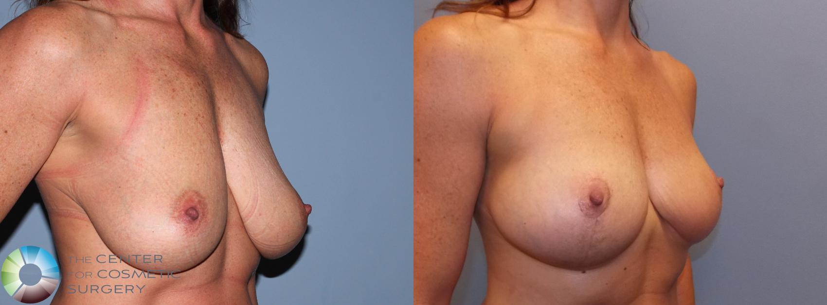 Before & After Breast Lift Case 868 View #3 in Denver and Colorado Springs, CO