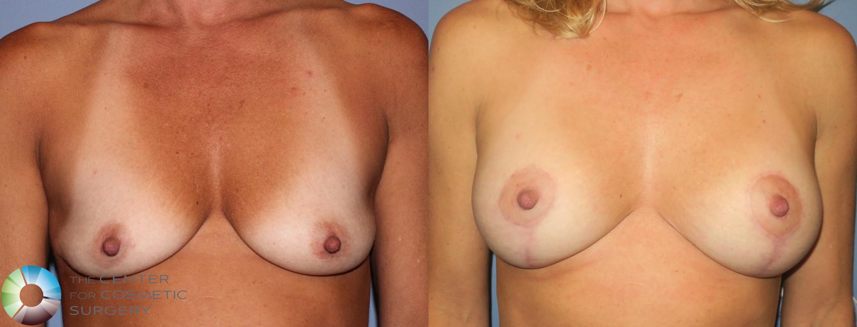 Before & After Breast Lift Case 889 View #1 View in Golden, CO