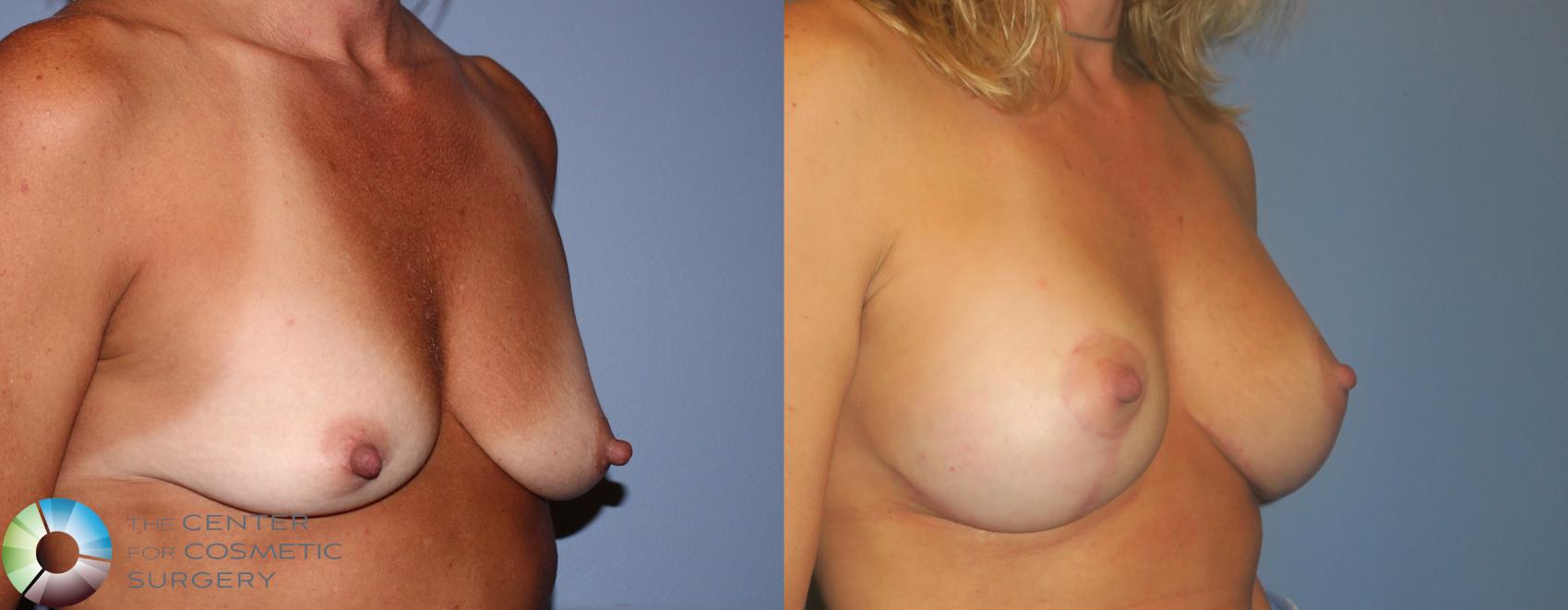 Before & After Breast Lift Case 889 View #2 in Denver and Colorado Springs, CO
