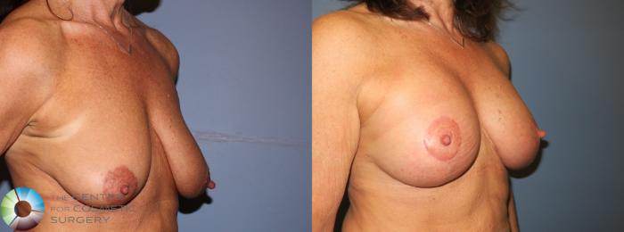 Before & After Breast Lift Case 890 View #1 View in Golden, CO