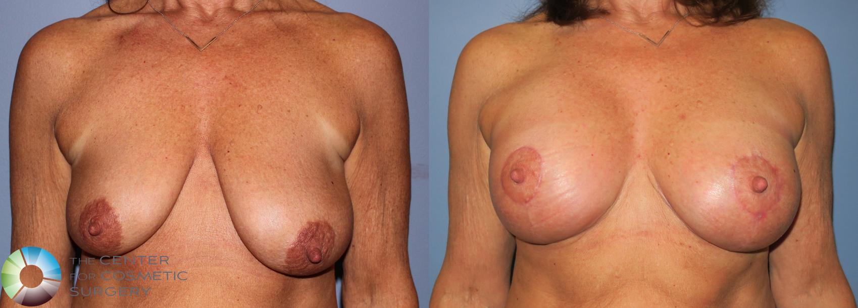 Before & After Breast Lift Case 890 View #3 in Denver and Colorado Springs, CO