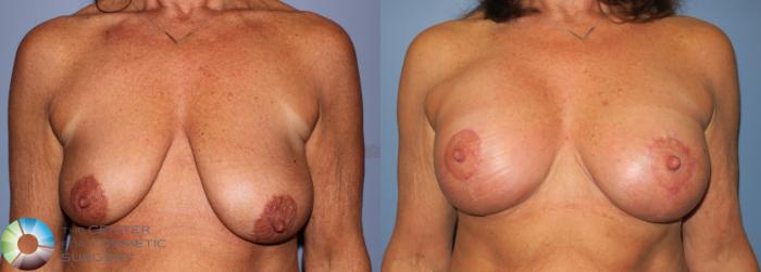 Before & After Breast Lift Case 890 View #3 View in Golden, CO