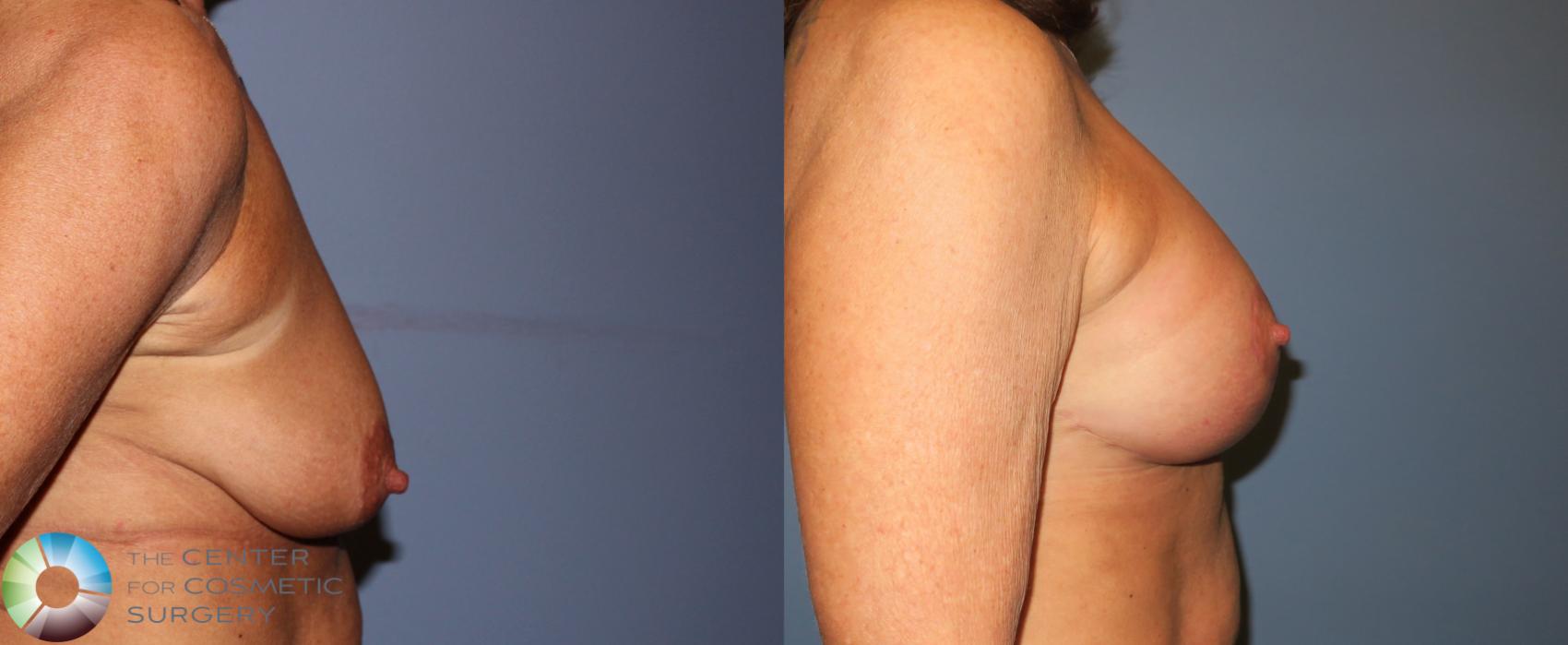 Before & After Breast Lift Case 890 View #4 in Denver and Colorado Springs, CO