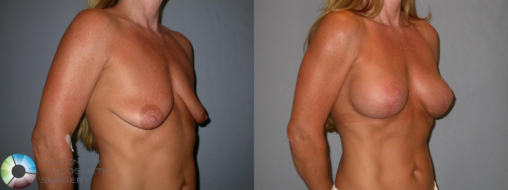 Before & After Breast Lift Case 94 View #1 in Denver, CO