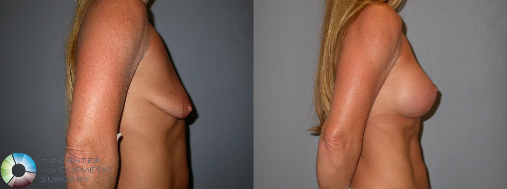 Before & After Breast Lift Case 94 View #2 View in Golden, CO