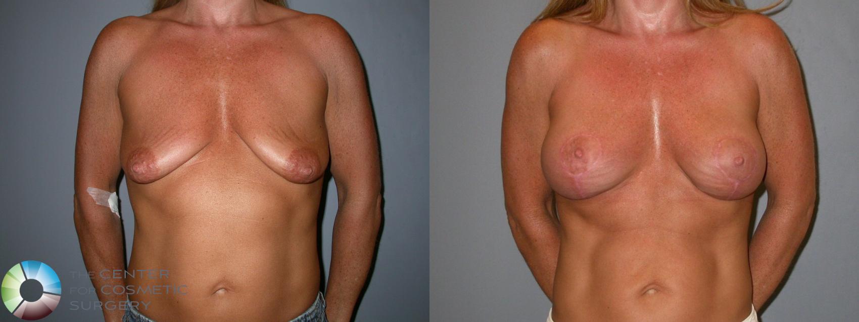 Before & After Breast Lift Case 94 View #3 View in Golden, CO