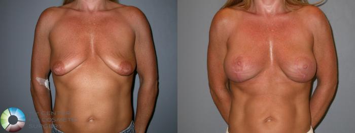 Before & After Breast Lift Case 94 View #3 View in Golden, CO