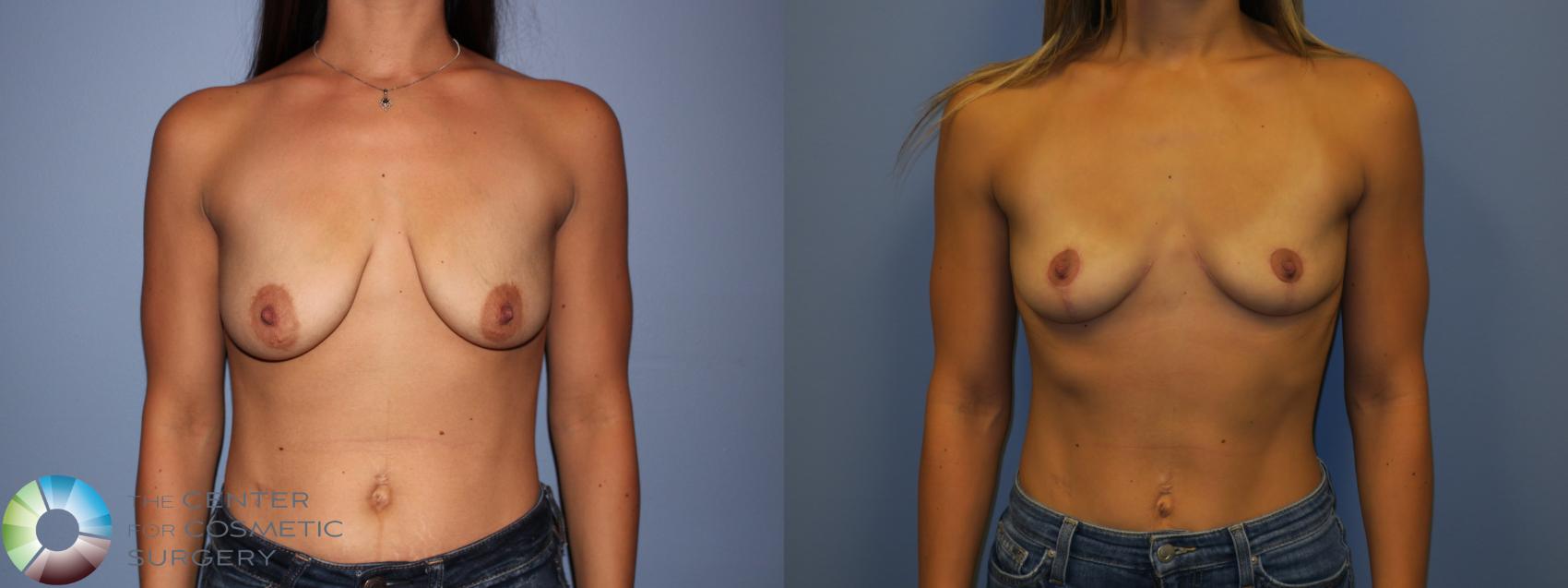 Before & After Breast Lift without Implants Case 11516 Front View in Golden, CO