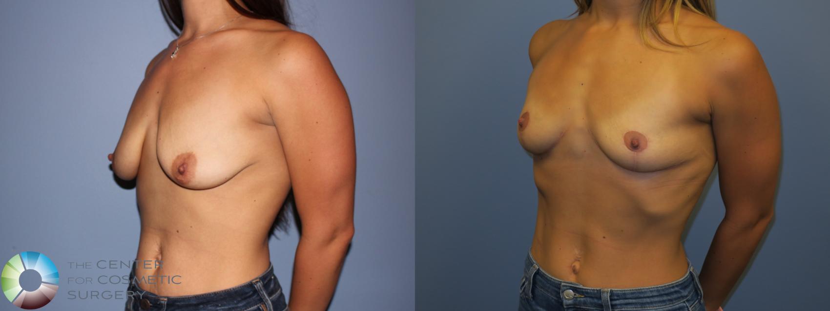 Before & After Breast Lift without Implants Case 11516 Left Oblique View in Golden, CO
