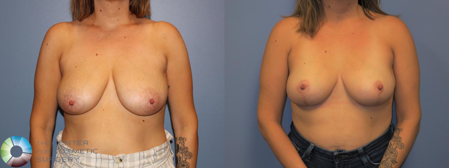 Before & After Breast Lift without Implants Case 11518 Front View in Denver & Golden, CO