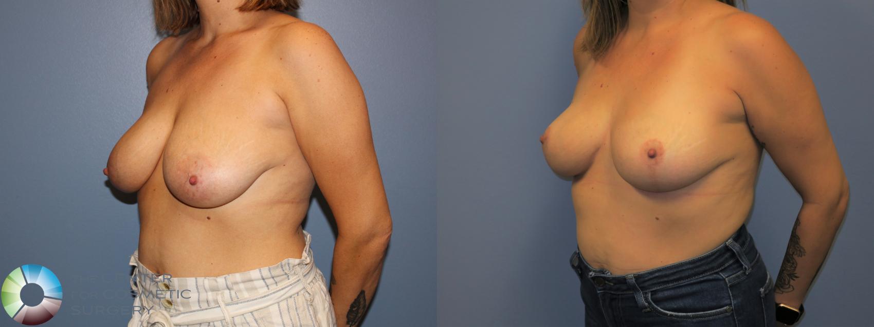 Before & After Breast Lift without Implants Case 11518 Left Oblique View in Golden, CO