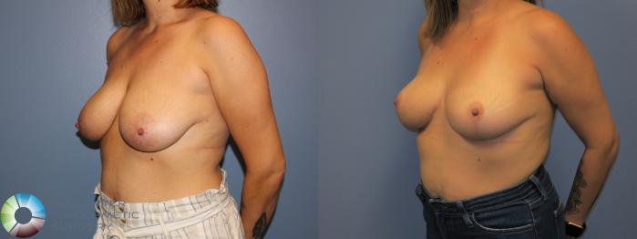 Before & After Breast Lift without Implants Case 11518 Left Oblique View in Golden, CO