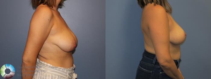 Before & After Breast Lift without Implants Case 11518 Right Side View in Golden, CO