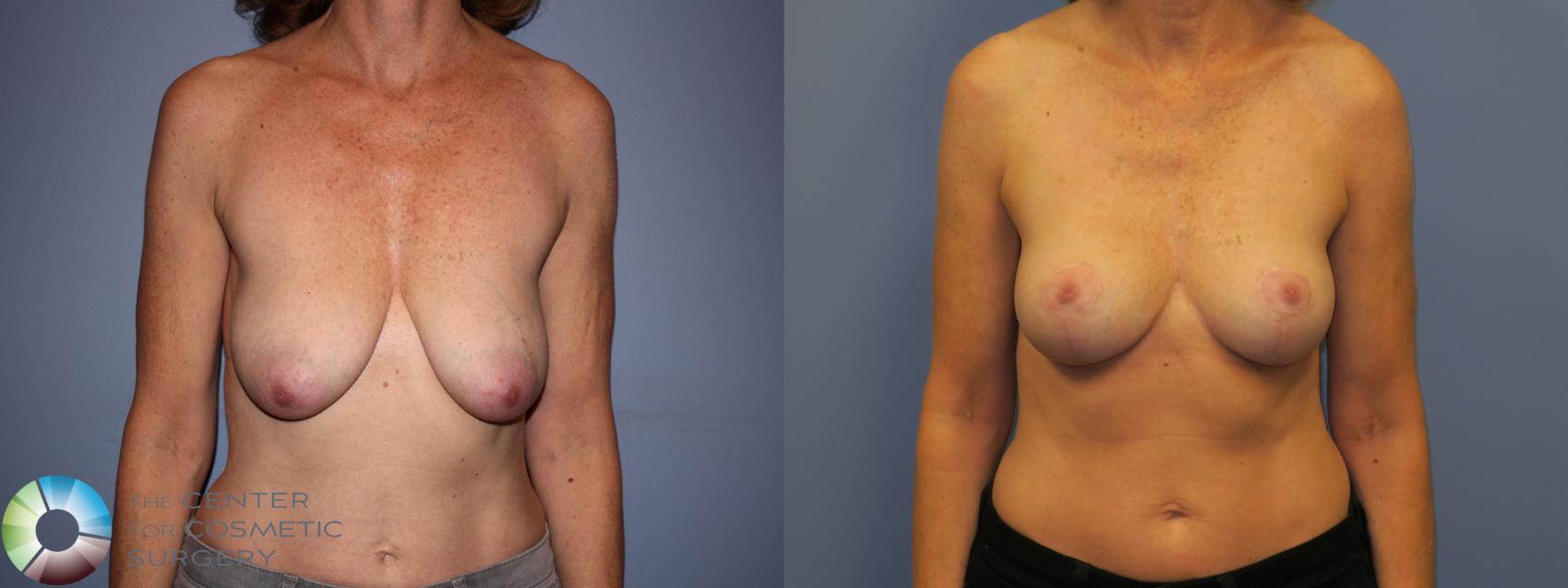 Before & After Breast Lift without Implants Case 11519 Front in Denver and Colorado Springs, CO