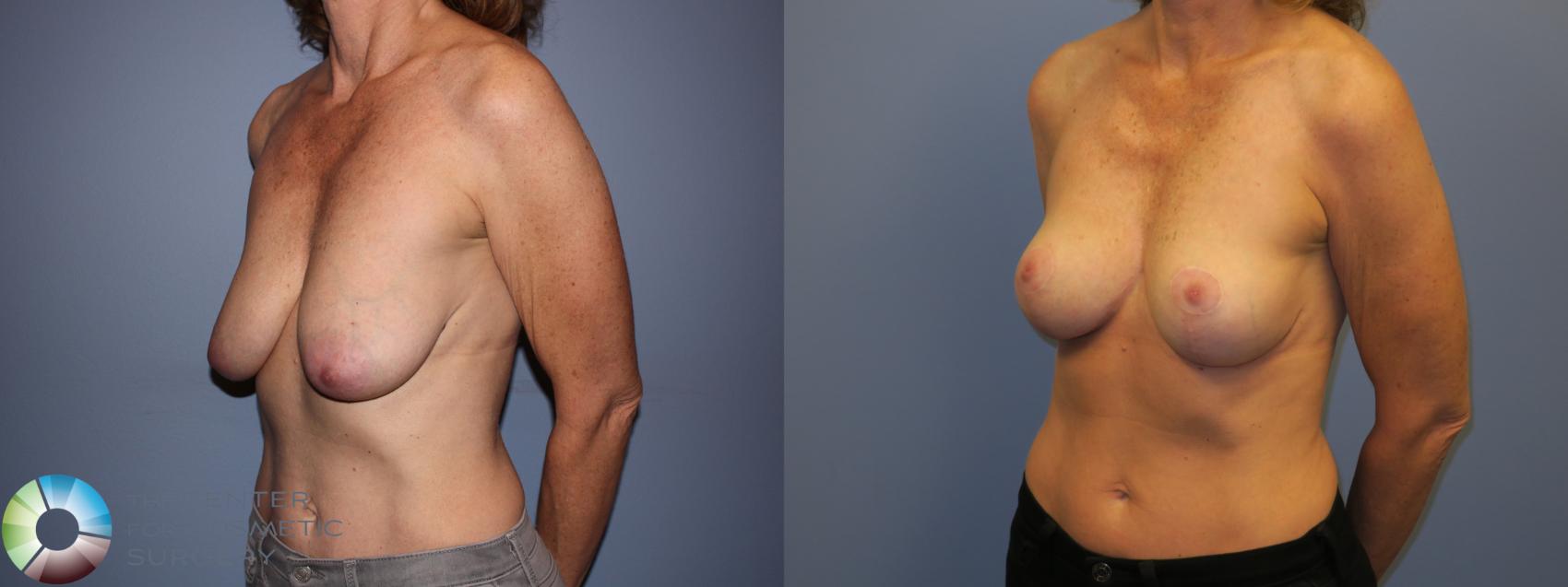Before & After Breast Lift without Implants Case 11519 Left Oblique in Denver and Colorado Springs, CO