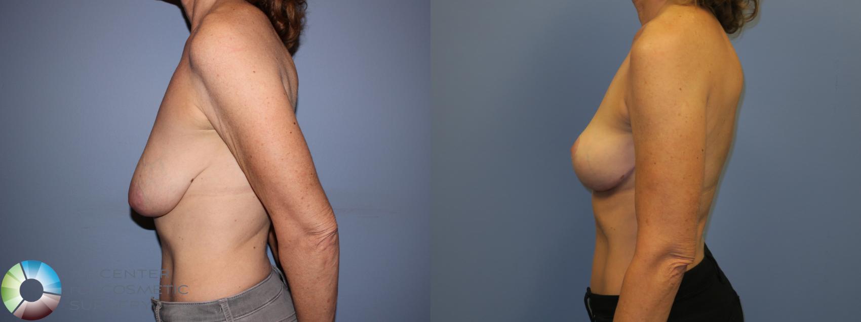 Before & After Breast Lift without Implants Case 11519 Left Side in Denver and Colorado Springs, CO